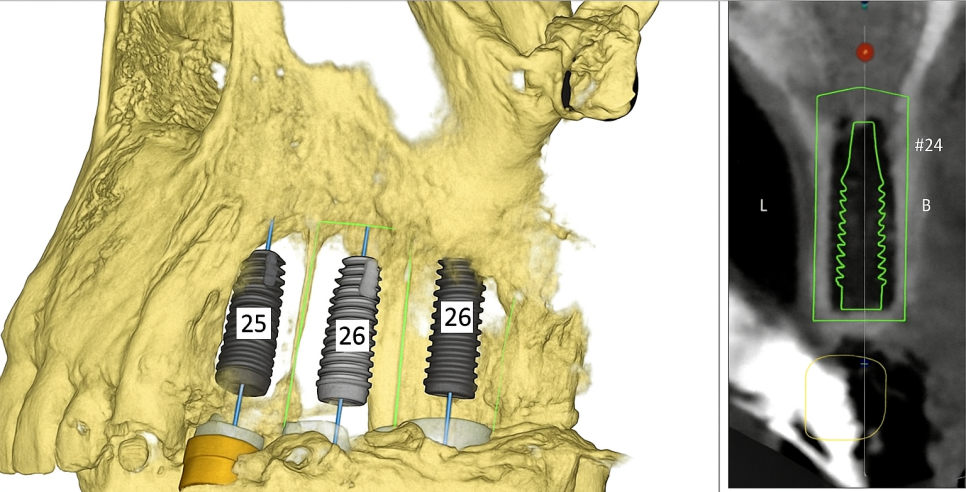 강서구 치과 어금니 임플란트 가용골 부족할 때 네비게이션 1차 2차 수술 로 해결하는 방법 관련 이미지 7