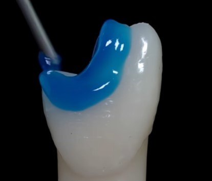 마곡동 치과 치아 파절 로 인한 레진 치료, 어떤 경우에 가능할까요? 관련 이미지 3