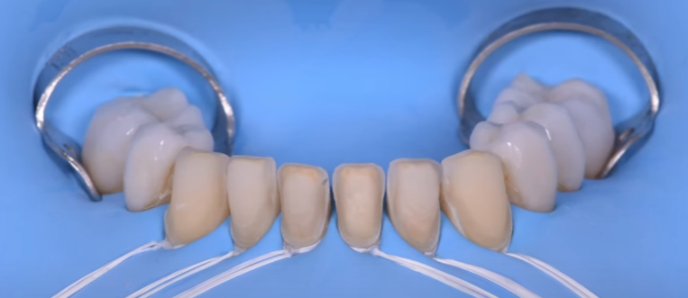 강서구 치과 앞니 라미네이트 제작을 위한 단계 진단 및 분석 절차 과정은? 관련 이미지 7