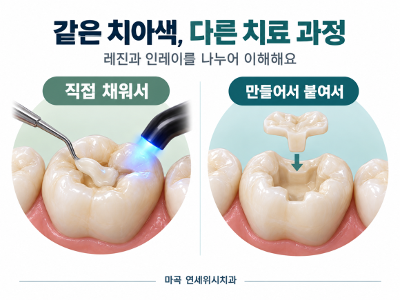 마곡 치아색 충치치료, 레진과 인레이가 다르게 들리는 이유 관련 이미지 1