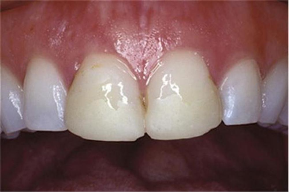 송정 치과 앞니 레진 변색 제거 후 전치부 치아 라미네이트 과정 관련 이미지 2