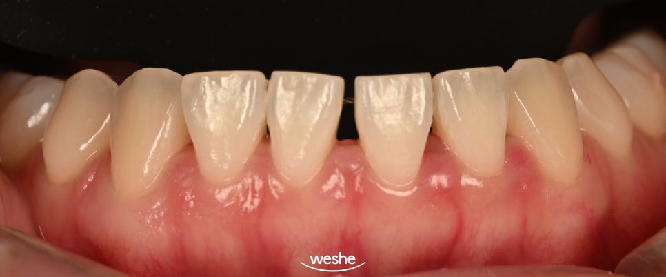 [마곡 치과] 교정 후 다시 벌어진 앞니, 재교정 없이 무삭제 라미네이트로 해결 하는 방법 을 알려드리겠습니다. (원내기공실) 관련 이미지 3