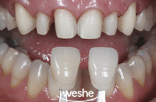 송정 치과 치아 배열이 틀어졌을 때, 앞니 라미네이트 치료 과정 관련 이미지 6