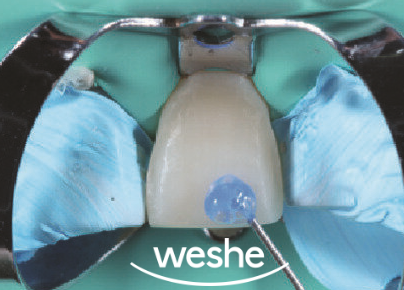 앞니 끝 깨짐 발산 치과 치아 라미네이트 치료 과정 관련 이미지 9