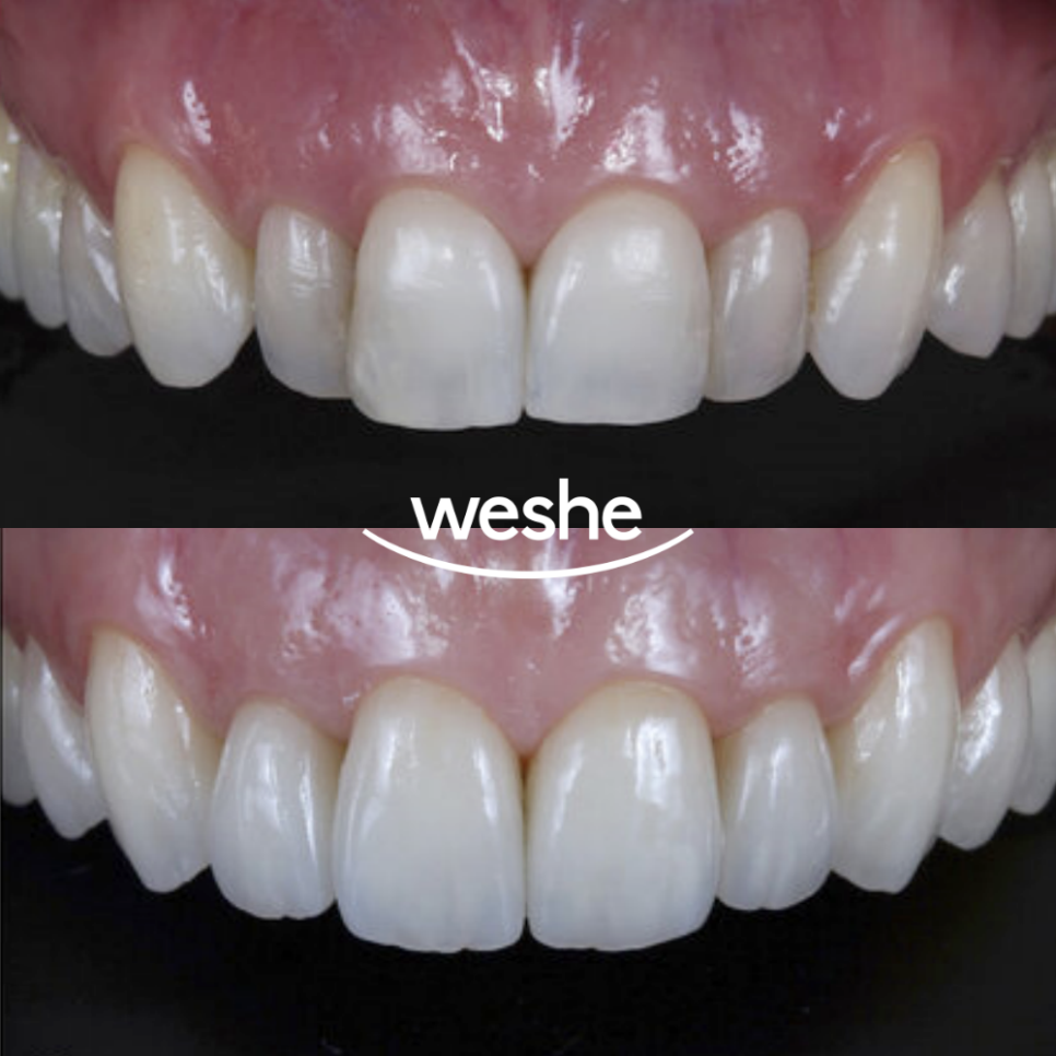 송정 치과 치아 배열이 틀어졌을 때, 앞니 라미네이트 치료 과정 관련 이미지 11