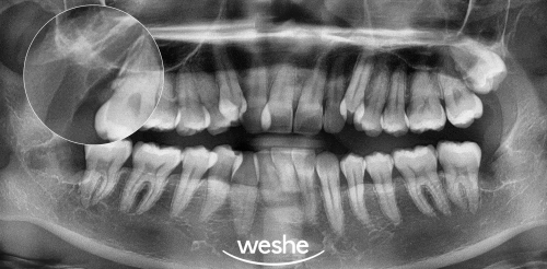 마곡역 수면치과 사랑니 발치 를 하는데 방해되는 덴탈 포비아, 극복할 수 있을까? 관련 이미지 5