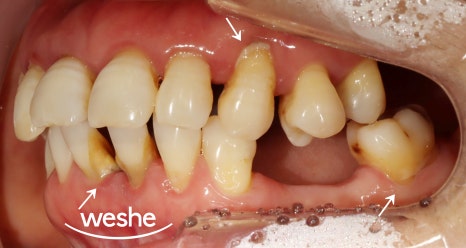 벌어진 치아 사이 (치간이개) 와 치주질환 이 동시에 있을 때, 송정역 치과 임플란트 치료 설명글 관련 이미지 4