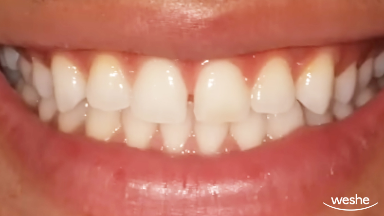 송정역 치과 앞니가 벌어졌을 때, 심미치료를 위한 라미네이트 제작 시 고려사항 관련 이미지 1