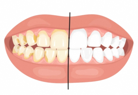 Gangseo-gu Dental Clinic: Wondering Whether to Choose Whitening, Orthodontics, or Veneers? image 4