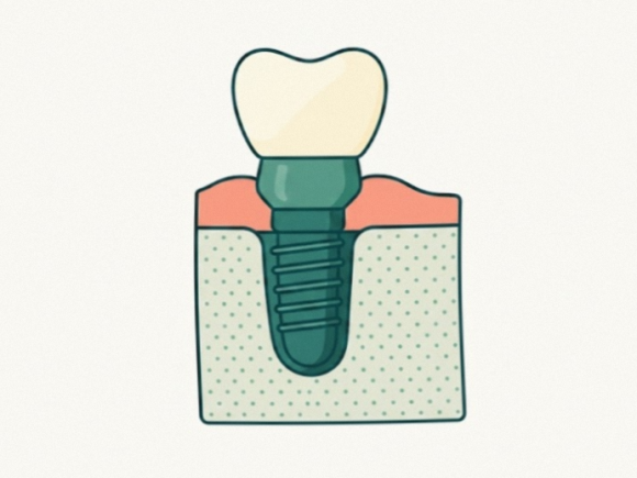 Magok Station Dental Clinic: Feeling Nervous and Shaky Before Implant Surgery? Knowledge Is Power image 5