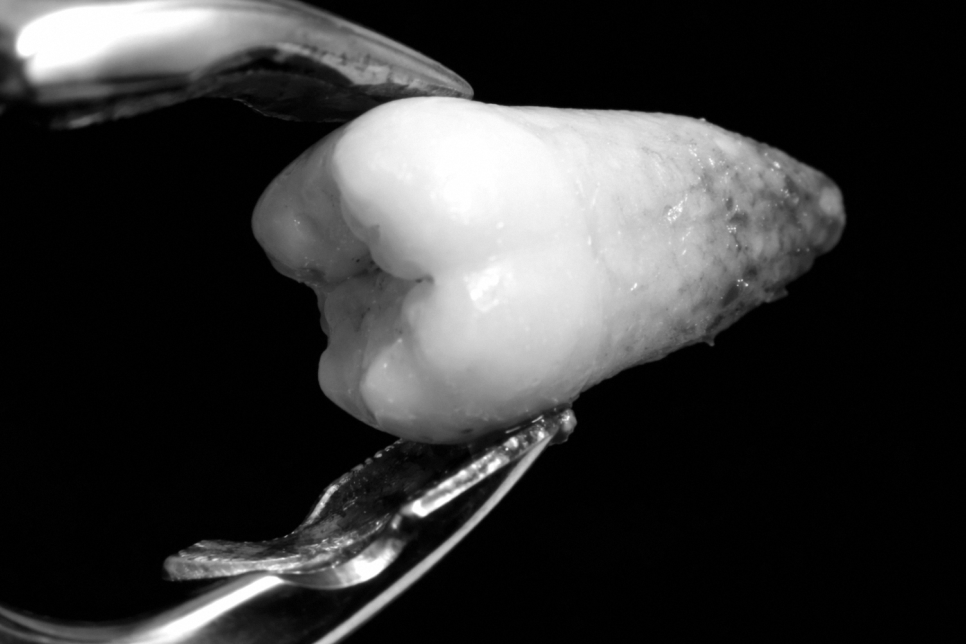 발치 선고를 받은 치아 마지막 선택지로서의 의도적 치아 재식술 마곡역 치과 관련 이미지 3