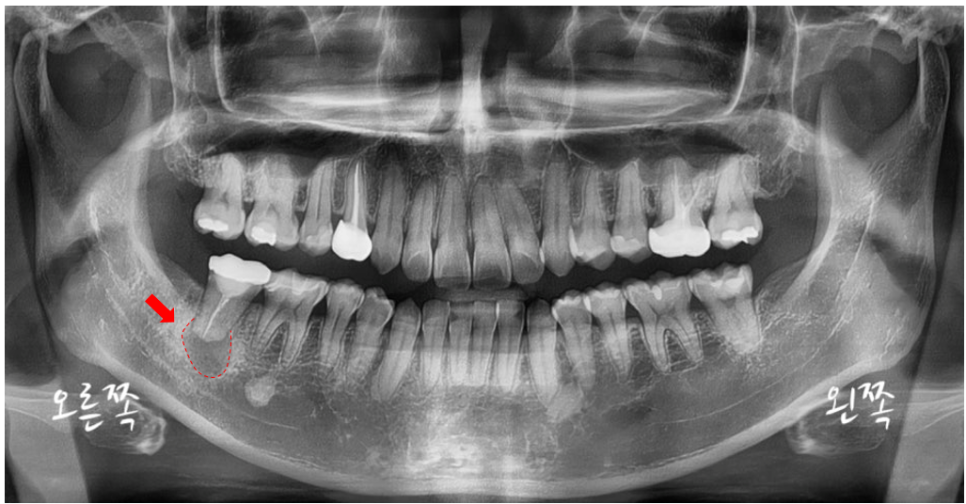 치과에서는 왜 자꾸 x-ray를 찍자고 하나요? 관련 이미지 4