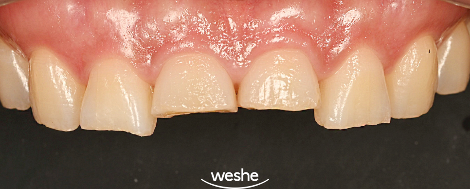 앞니 치아 파절, 마곡 치과 치료 기준과 지르코니아 크라운의 심미적 비율 관련 이미지 1