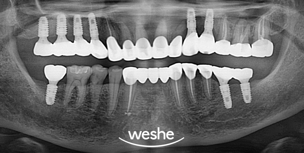 마곡역 치과 기공실과 기공소의 차이와 그에 따른 임플란트 진료 과정 관련 이미지 15