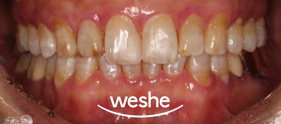 에어플로우와 초음파 스케일링 차이점과 단계별 치료 과정 강서구 치과 관련 이미지 8