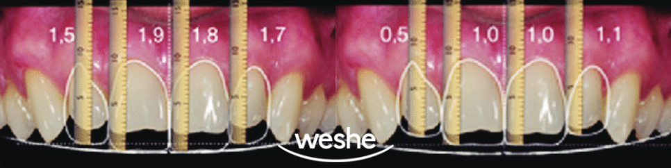 발산 치과 왜소치 치료, 레진과 치아 라미네이트 중 어떤 것이 좋을까? 진료 방법 차이와 보철 수복 과정 관련 이미지 3