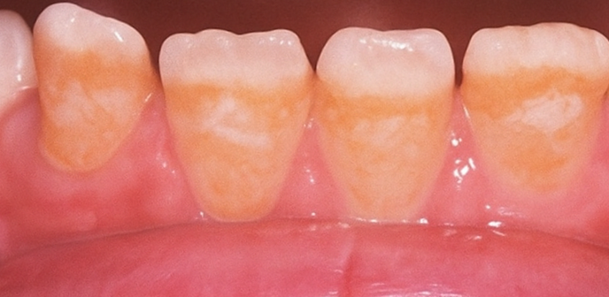 얼룩덜룩한 치아, 단순 착색, 변색일까요? 강서구 치과 법랑질 저형성증 치료법 소개글 관련 이미지 5