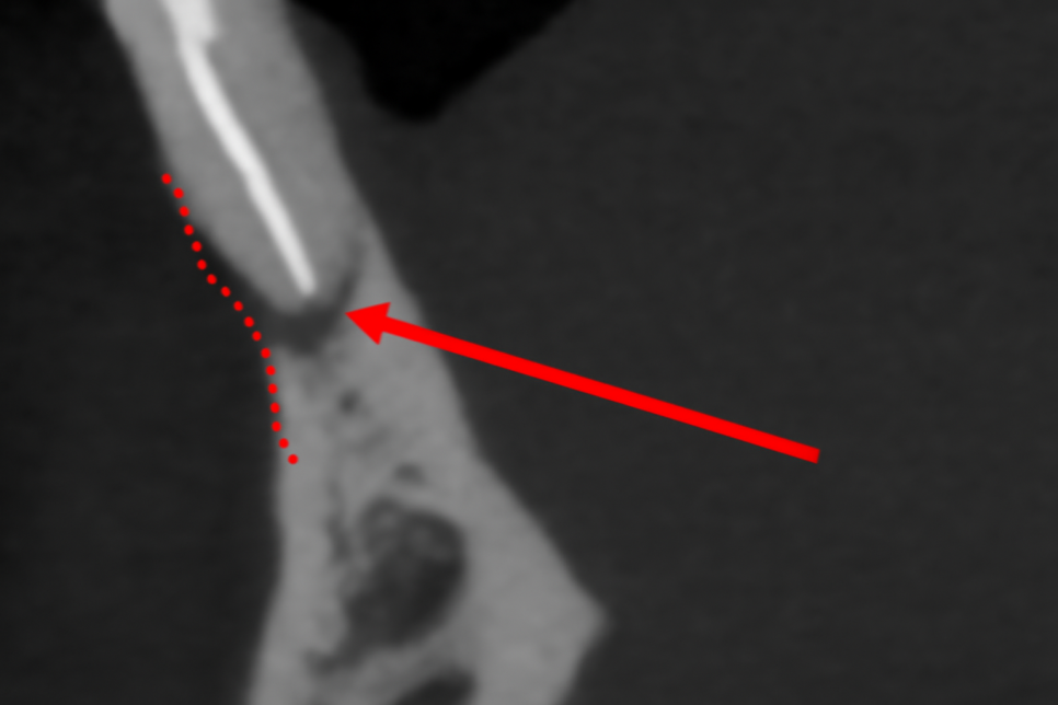마곡동 치과 치주질환으로 인한 치아 벌어짐, 그리고 임플란트 치료 과정 관련 이미지 5