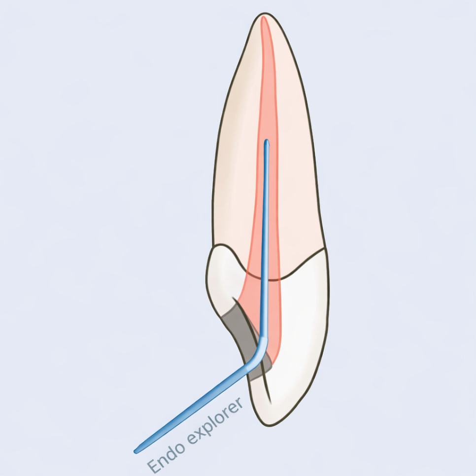 마곡 치과 라미네이트 , 앞니 신경치료 후 크라운 대신 가능한 경우 3가지 관련 이미지 2