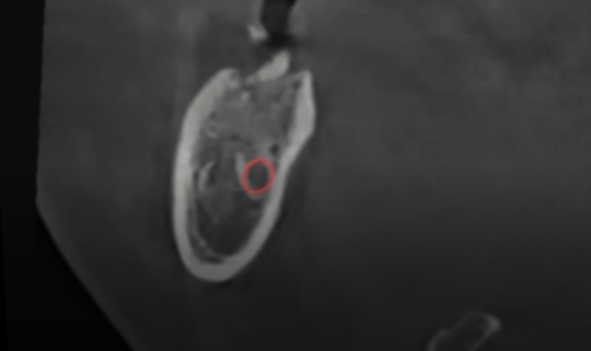 강서구 치과 어금니 임플란트 가용골 부족할 때 네비게이션 1차 2차 수술 로 해결하는 방법 관련 이미지 2