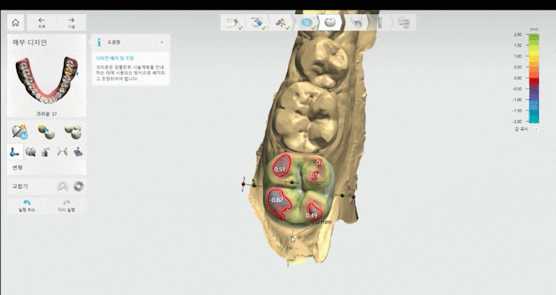 연세위시치과 여상호 대표원장이 알려주는 임플란트 시술 방법부터 과정, 전후 관리 관련 이미지 4