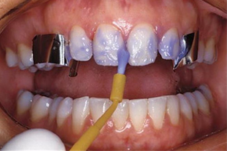 송정 치과 앞니 레진 변색 제거 후 전치부 치아 라미네이트 과정 관련 이미지 8