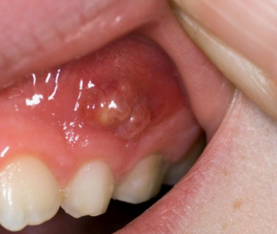 A Pus Pocket on the Gums: Will It Get Better with Antibiotics Alone? image 4