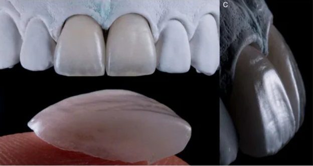앞니 끝 깨짐 연세위시치과 라미네이트 제작 과정, 관리 관련 이미지 4