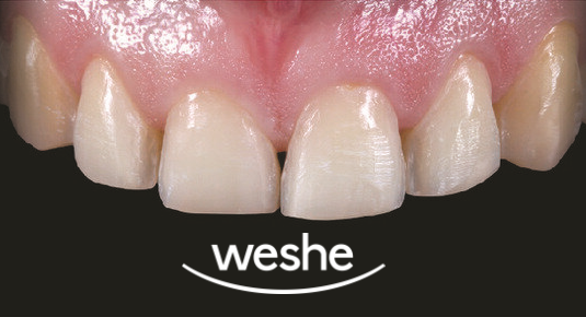 앞니 끝 깨짐 발산 치과 치아 라미네이트 치료 과정 관련 이미지 5