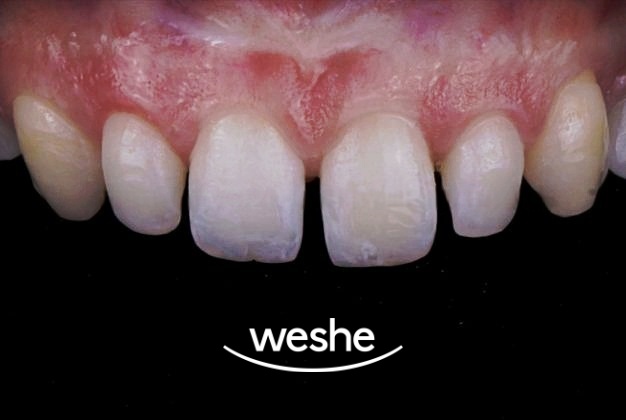 😁 웃을 때 치아 사이 가 벌어져 보인다면? 마곡동 치과 라미네이트 로 해결! 관련 이미지 5