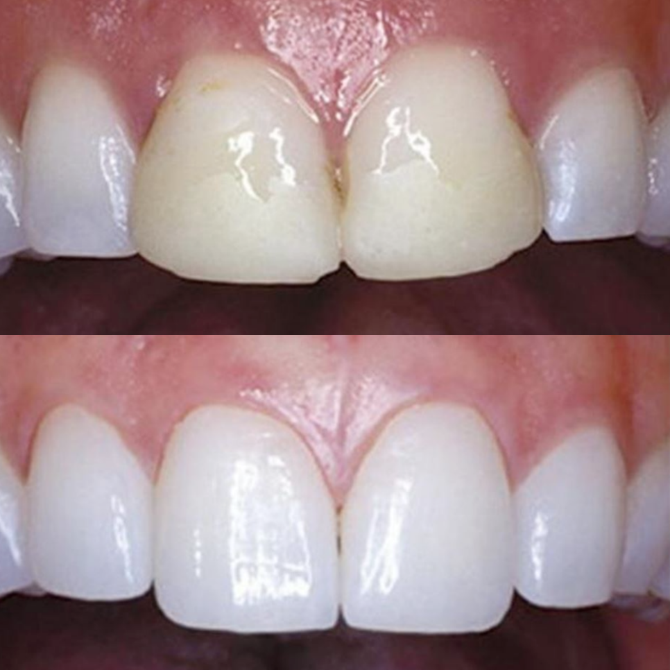 송정 치과 앞니 레진 변색 제거 후 전치부 치아 라미네이트 과정 관련 이미지 13