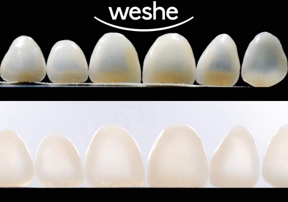 강서구 치과 웃을 때 앞니가 이상해 보인다면? 라미네이트 치료 로 자신감을 되찾으세요 관련 이미지 2