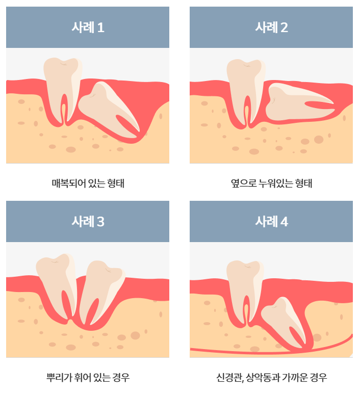 발산역 치과 매복 사랑니 발치 후 염증 통증 증상 어떡하지? 관련 이미지 2