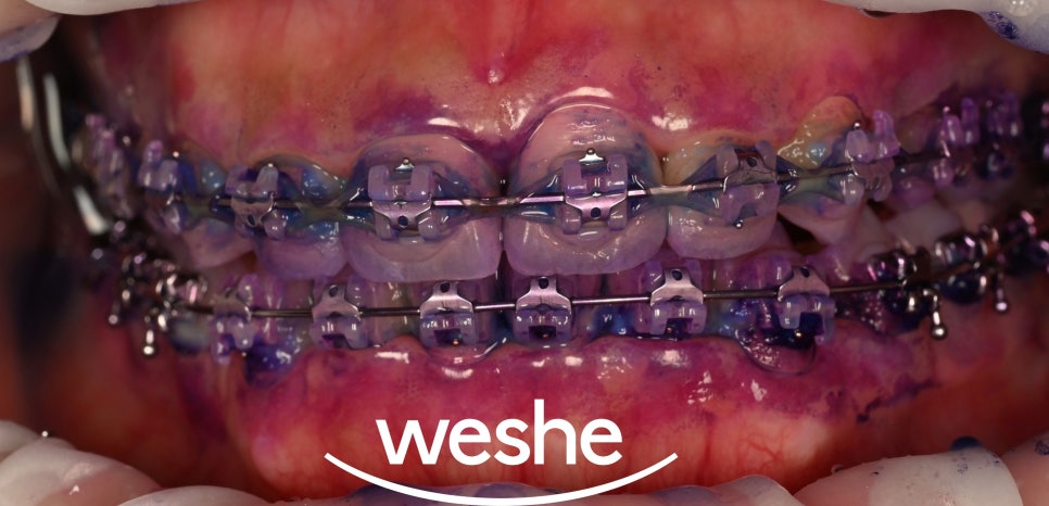 발산 치과 교정 중 칫솔질 어려우신가요? 브라켓 탈락 걱정 없이 깨끗하게, 에어플로우 세정 관련 이미지 3