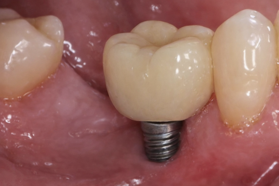 스케일링 후 시려서 미루고 계셨나요? 강서구 치과 에서 설명하는 에어플로우 관련 이미지 4