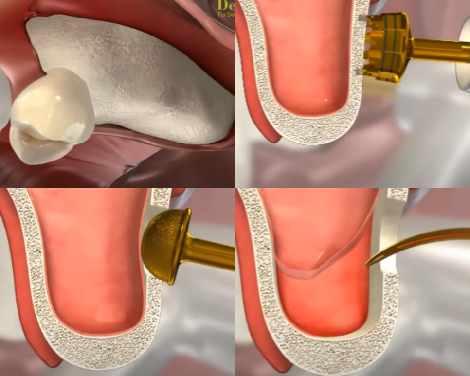 마곡역 치과 임플란트 식립 수술 시 필요한 상악동 거상술 종류 관련 이미지 4