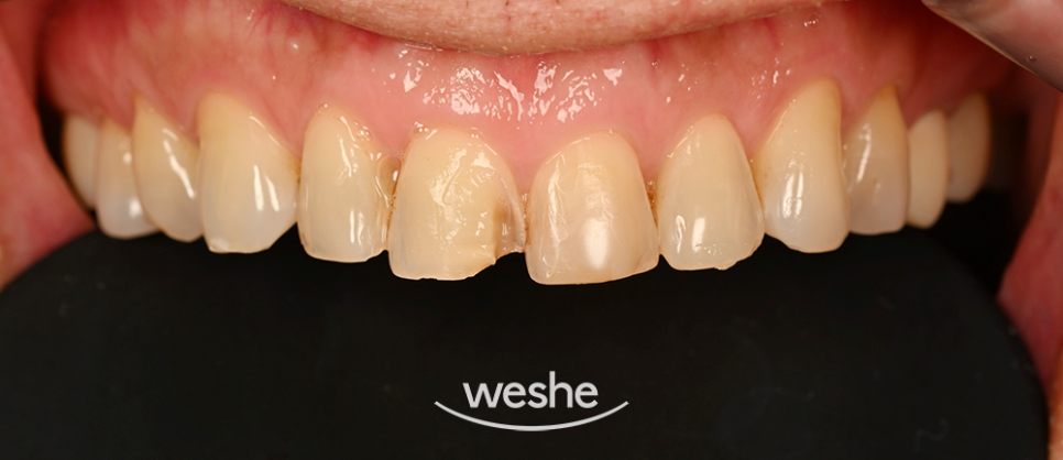 마곡역 치과 마모&middot;변색된 앞니, 레진 수복으로 자연스럽게 회복한 사례 관련 이미지 1