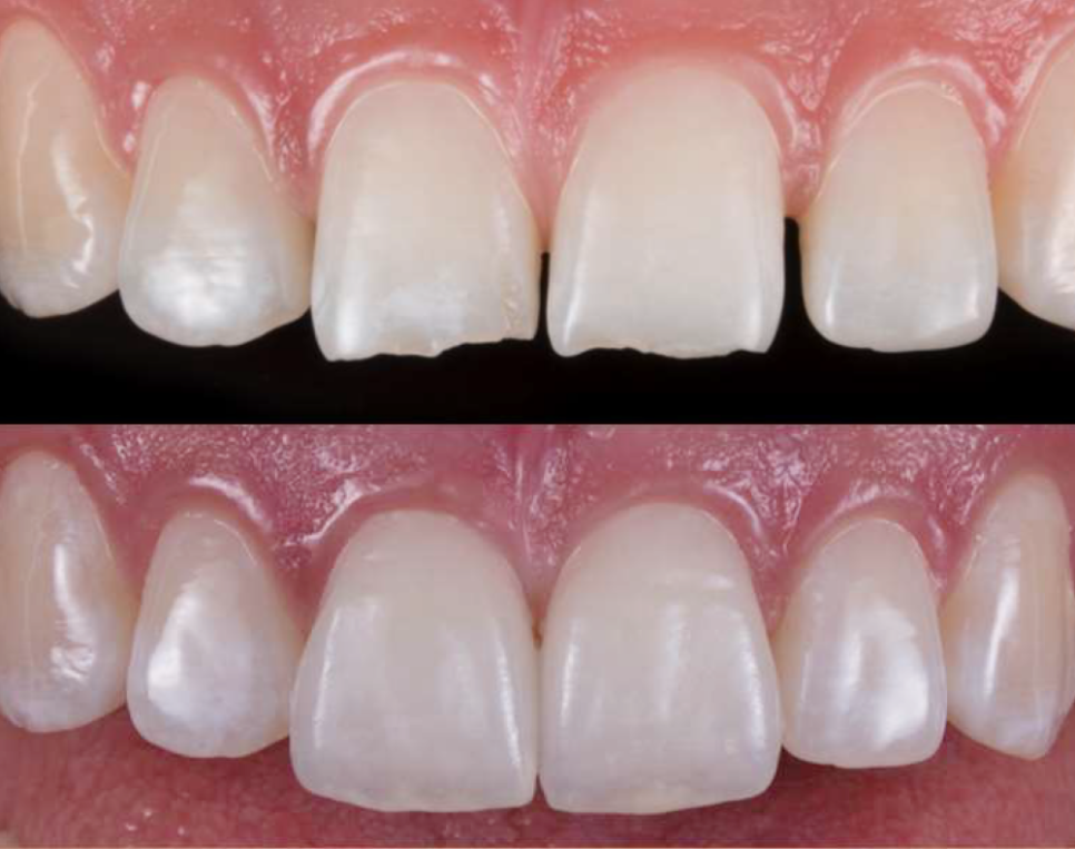 앞니 끝 깨짐 연세위시치과 라미네이트 제작 과정, 관리 관련 이미지 6