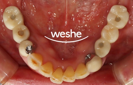 강서구 치과 어금니 임플란트 가용골 부족할 때 네비게이션 1차 2차 수술 로 해결하는 방법 관련 이미지 10