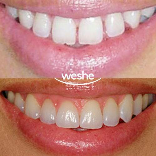 송정역 치과 치간이개(앞니 사이 벌어짐)의 원인과 해결법, 라미네이트 수복 과정 정리 관련 이미지 4