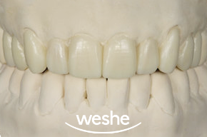 송정 치과 치아 배열이 틀어졌을 때, 앞니 라미네이트 치료 과정 관련 이미지 3