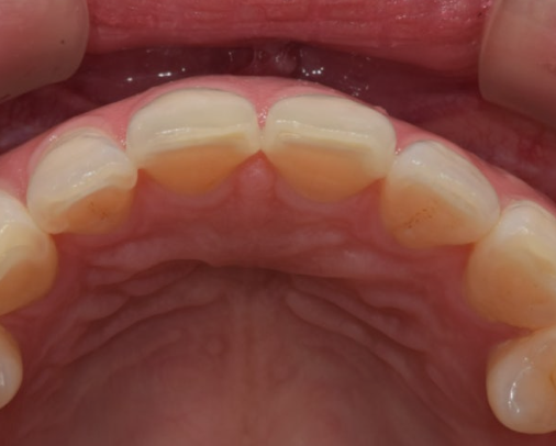 Can Teeth Break Because of Teeth Grinding? Magongnaru Station Dental Clinic image 3