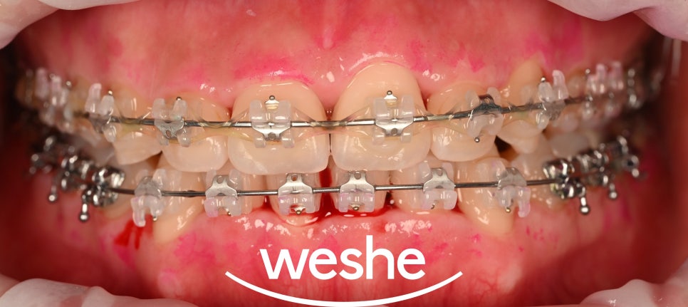 발산 치과 교정 중 칫솔질 어려우신가요? 브라켓 탈락 걱정 없이 깨끗하게, 에어플로우 세정 관련 이미지 6