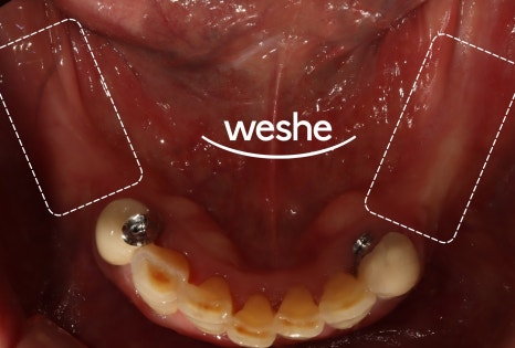 강서구 치과 어금니 임플란트 가용골 부족할 때 네비게이션 1차 2차 수술 로 해결하는 방법 관련 이미지 5