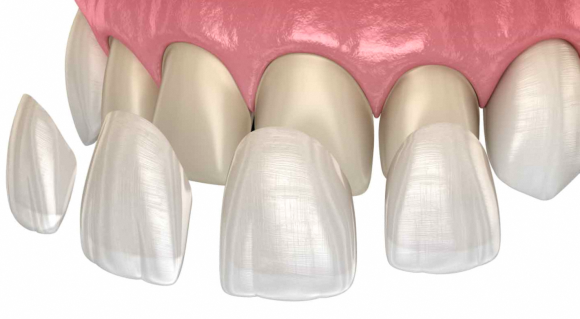 Gangseo-gu Dental Clinic: Wondering Whether to Choose Whitening, Orthodontics, or Veneers? image 3