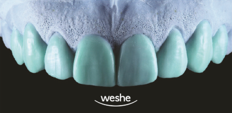 앞니 끝 깨짐 발산 치과 치아 라미네이트 치료 과정 관련 이미지 3