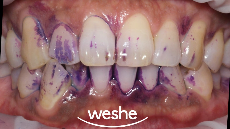 마곡역 치과 에어플로우, 연 1회 스케일링 을 아직 받지 않으셨나요? 연말 전 꼭! 받아야 되는 이유를 설명해 드리겠습니다. 관련 이미지 2