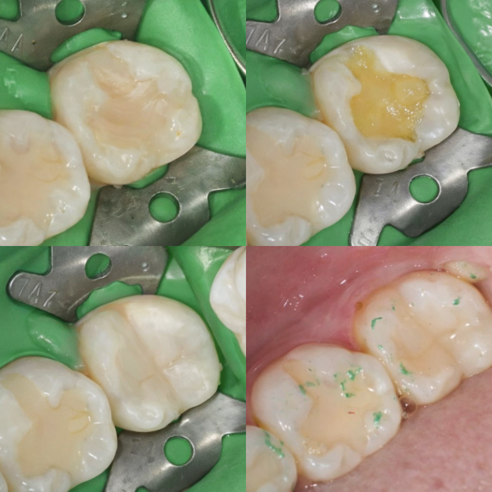 마곡 치과  앞니 깨짐, 크라운 없이 레진으로 치료가 가능할까? 진료 방법을 선택하는 기준과 과정 관련 이미지 4