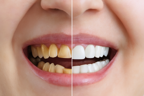 얼룩덜룩한 치아, 단순 착색, 변색일까요? 강서구 치과 법랑질 저형성증 치료법 소개글 관련 이미지 3