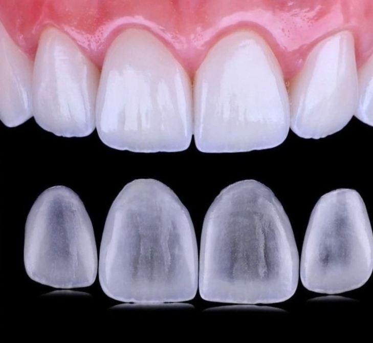 마곡역 치과 "재교정을 하며 6개월을 기다려야 될까요?" 직장인을 위한 앞니 벌어짐 개선 방법 무삭제 라미네이트 관련 이미지 3